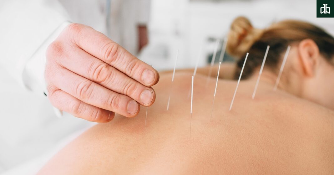 Acupuncture